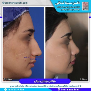 جراحی-بینی-کرج-75