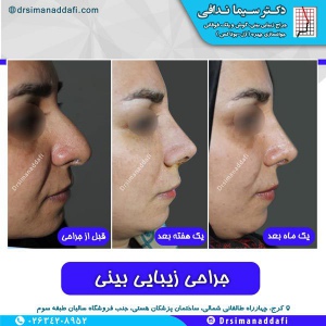 جراحی-بینی-کرج-76