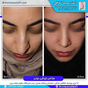جراحی-بینی-کرج-77