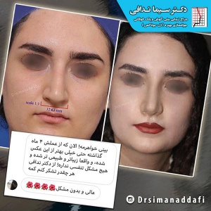 جراحی-بینی-کرج-78
