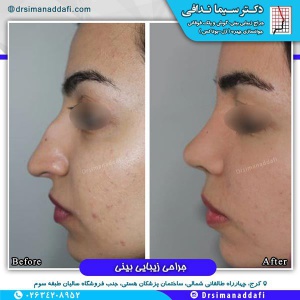 جراحی-بینی-کرج-85