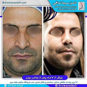 جراحی-بینی-کرج-91