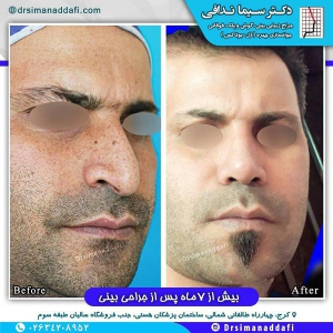 جراحی-بینی-کرج-92