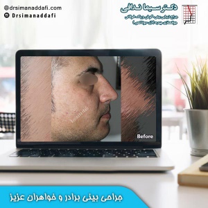 جراحی-بینی-کرج-98