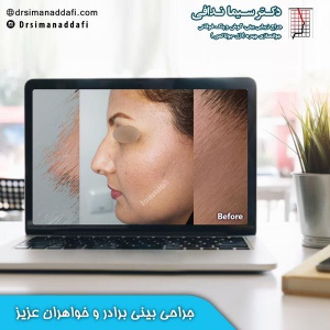 جراحی-بینی-کرج-99