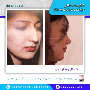 جراحی-بینی-10