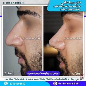 جراحی-بینی-100-1