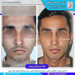 جراحی-بینی-100-10