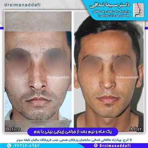 جراحی-بینی-100-11