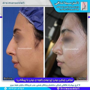 جراحی-بینی-100-12