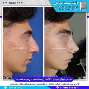 جراحی-بینی-100-13