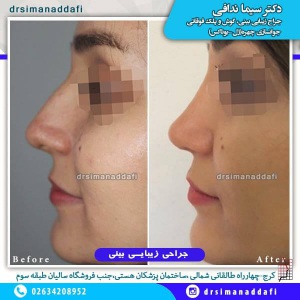 جراحی-بینی-100-14