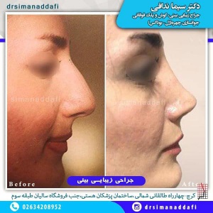 جراحی-بینی-100-2