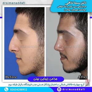 جراحی-بینی-100-3