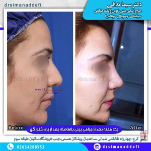 جراحی-بینی-100-4