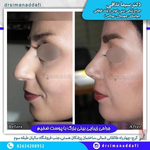 جراحی-بینی-100-5