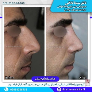 جراحی-بینی-100-6