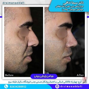 جراحی-بینی-100-7