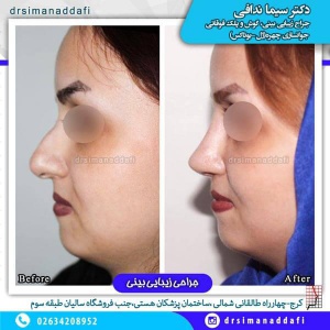 جراحی-بینی-100-8