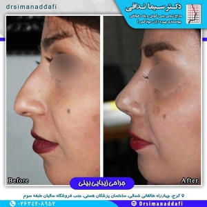 جراحی-بینی-100-9