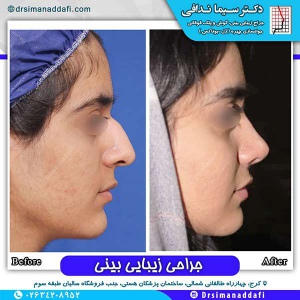 جراحی-بینی-100