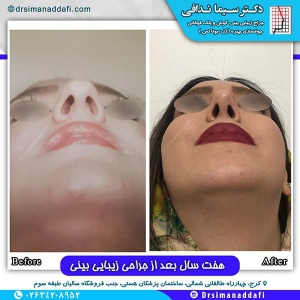 جراحی-بینی-102