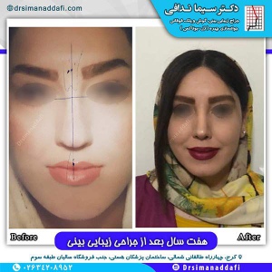 جراحی-بینی-103