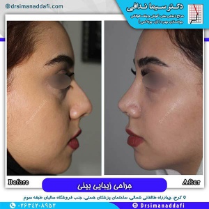 جراحی-بینی-105