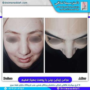 جراحی-بینی-107