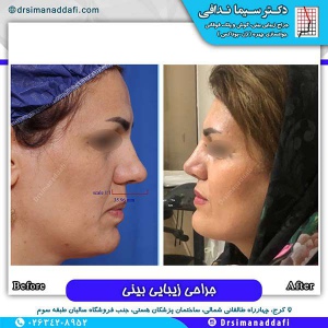جراحی-بینی-108