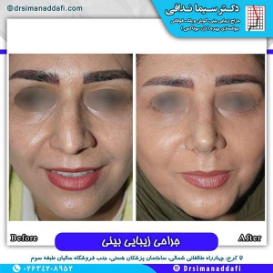 جراحی-بینی-109