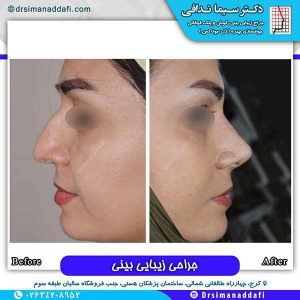 جراحی-بینی-110