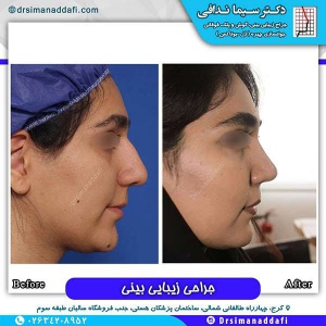 جراحی-بینی-111