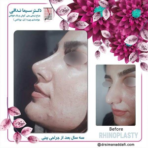 جراحی-بینی-113