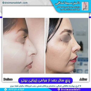 جراحی-بینی-114