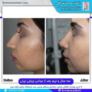 جراحی-بینی-115