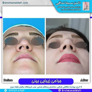 جراحی-بینی-116
