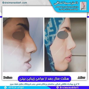 جراحی-بینی-117