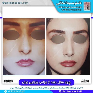 جراحی-بینی-118