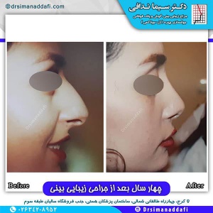 جراحی-بینی-119
