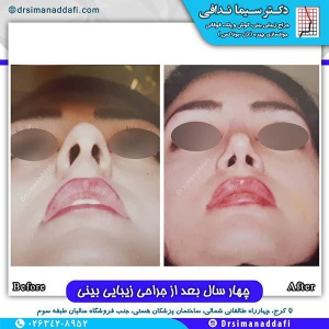 جراحی-بینی-120