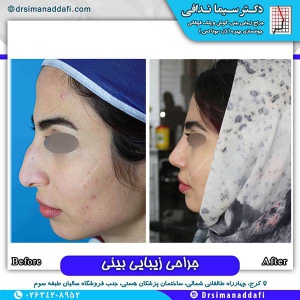 جراحی-بینی-123