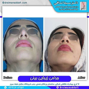 جراحی-بینی-124