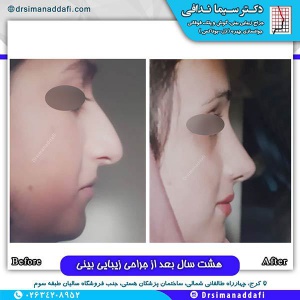 جراحی-بینی-125