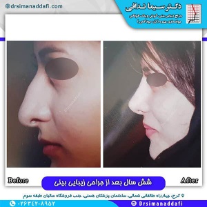 جراحی-بینی-126