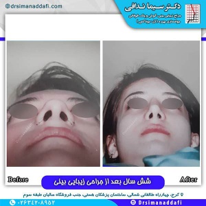جراحی-بینی-127