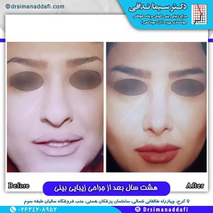 جراحی-بینی-128