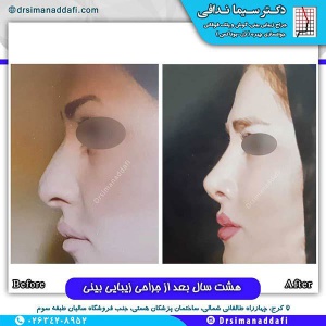 جراحی-بینی-129