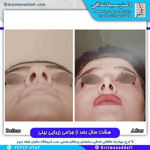 جراحی-بینی-130