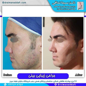 جراحی-بینی-131